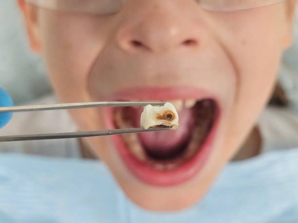Best Emergency Treatment for Toothache in Watertown, WI